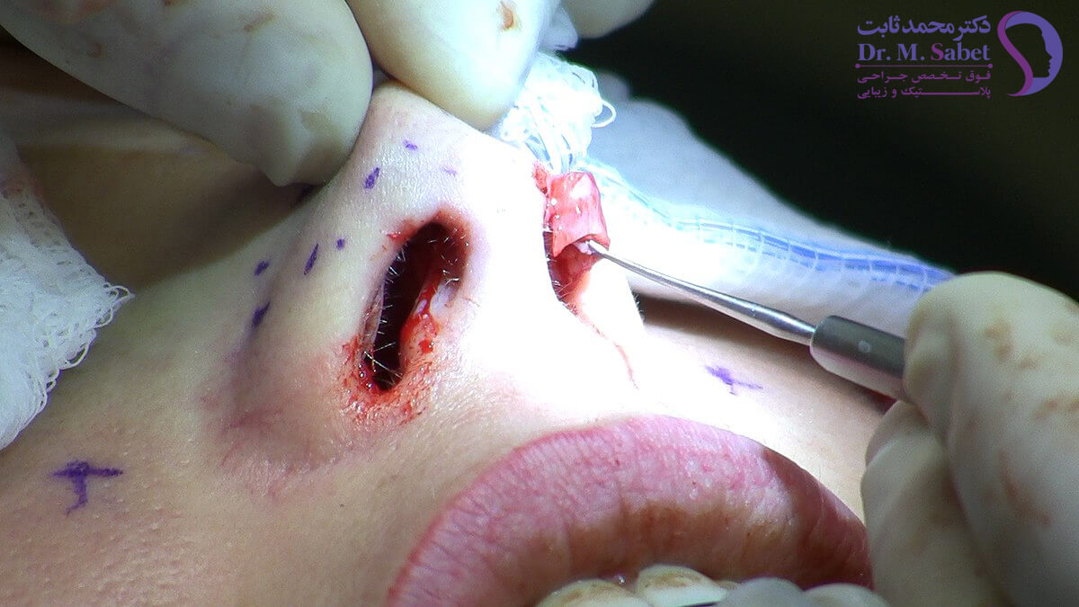 جراحی بینی | مزایای جراحی بینی بسته